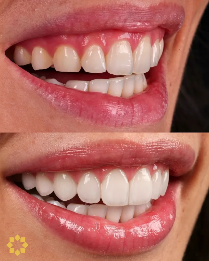Caso de estética dental en Prosmile Dental Córdoba