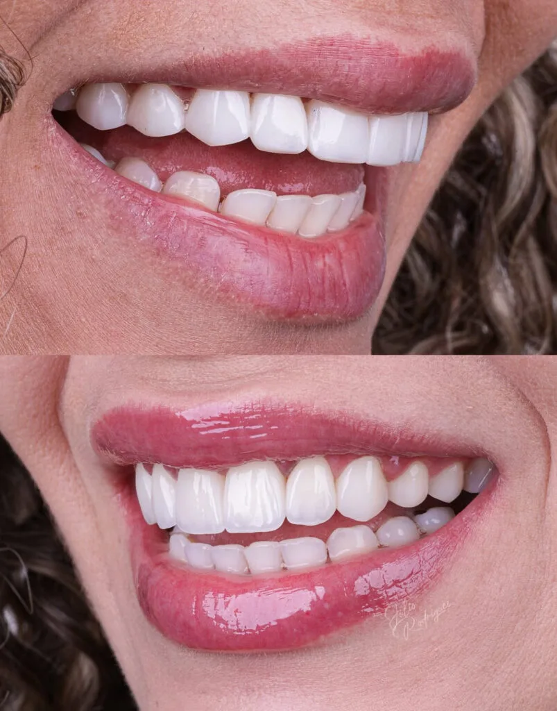 Sonrisa tras tratamiento de estética dental – Prosmile Dental Córdoba