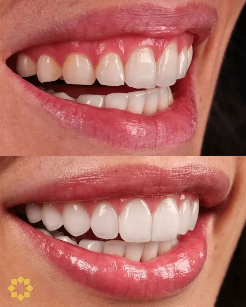 Caso de estética dental en Prosmile Dental Córdoba