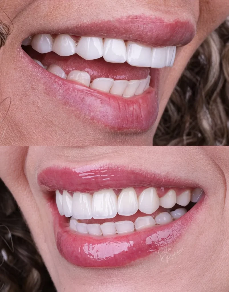 Sonrisa tras tratamiento de estética dental – Prosmile Dental Córdoba