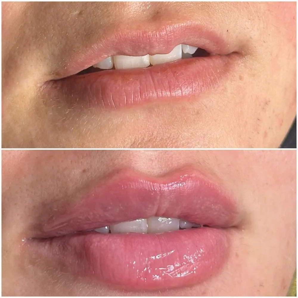 Armonización orofacial de labios antes y después