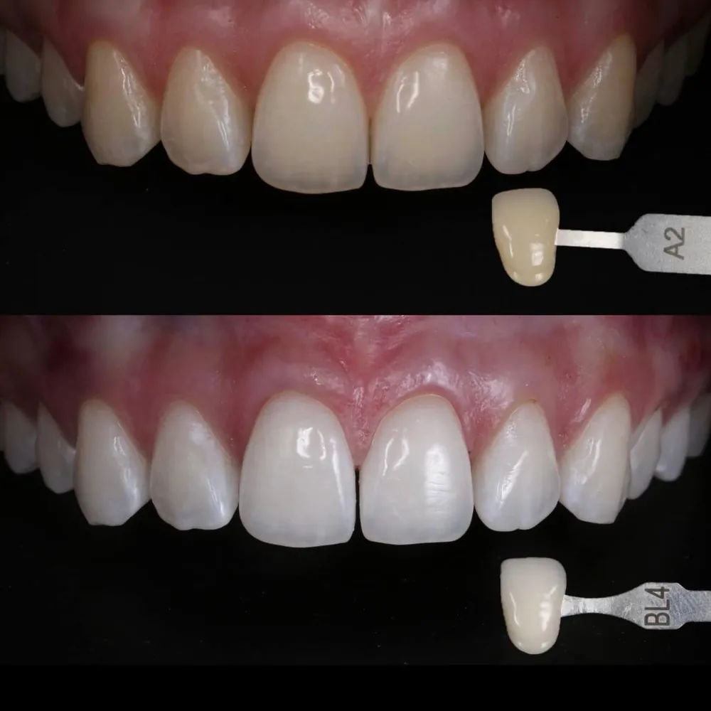 Blanqueamiento dental antes y después, de color A2 a BL4