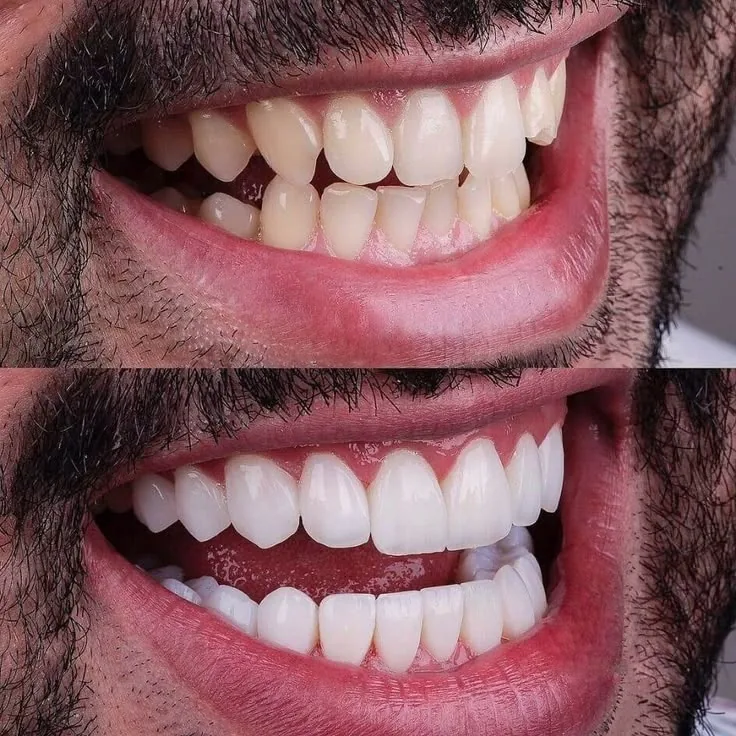 Antes y después de carillas dentales en Córdoba – caso 1