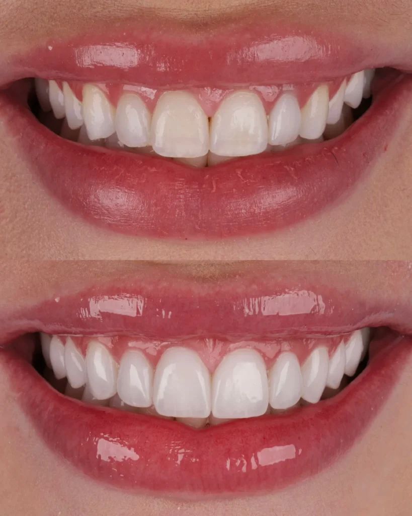 Antes y después de carillas dentales en Córdoba – caso 4