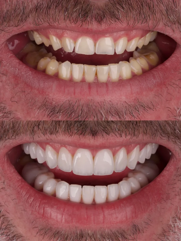 Antes y después de carillas dentales en Córdoba – caso 5