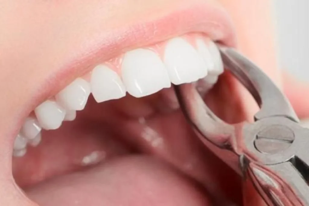 Como me cuido luego de una extracción dentaria Córdoba Argentina