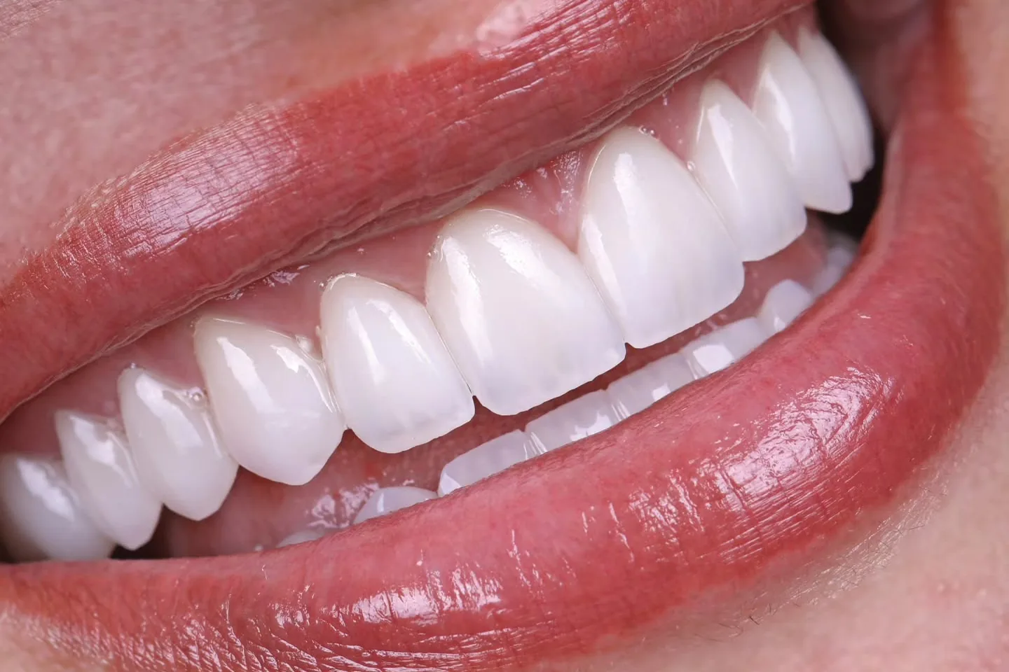 Sonrisa con carillas dentales de Prosmile Dental en Córdoba