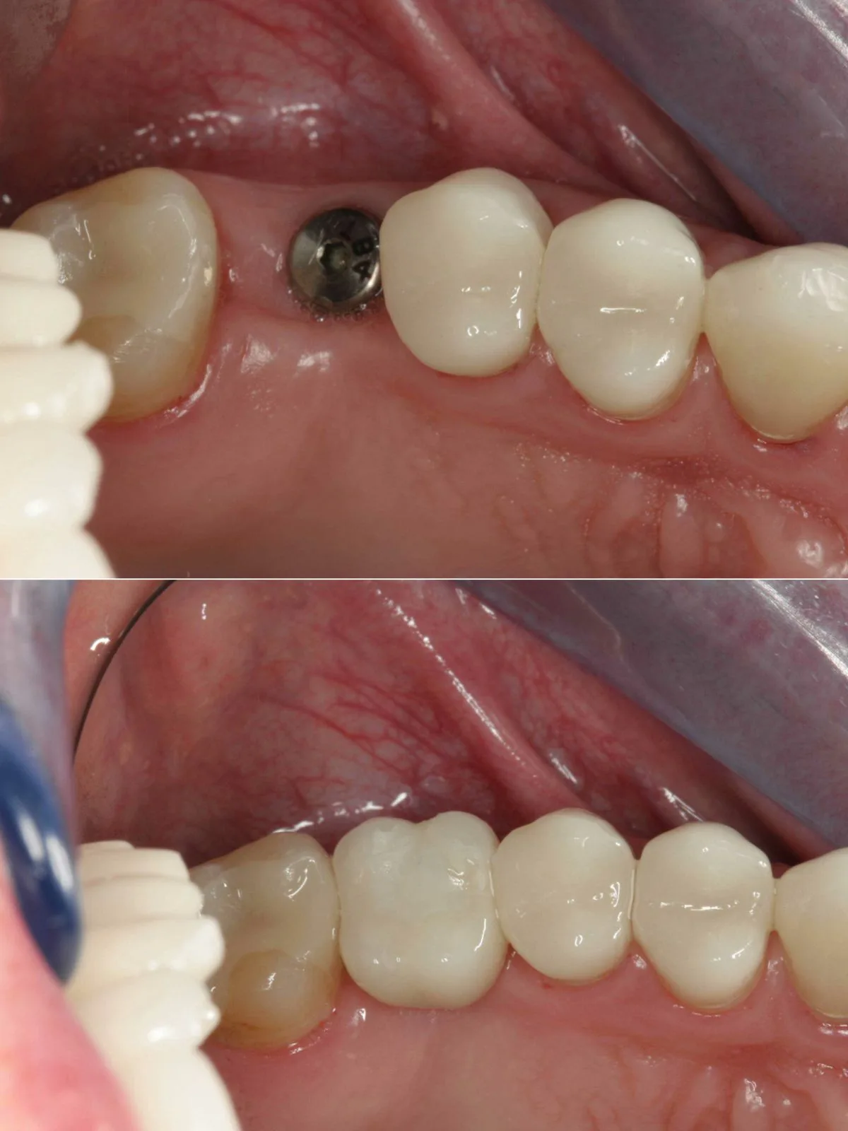 Implante dental antes y después: tornillo de cicatrización y corona definitiva en Prosmile Córdoba