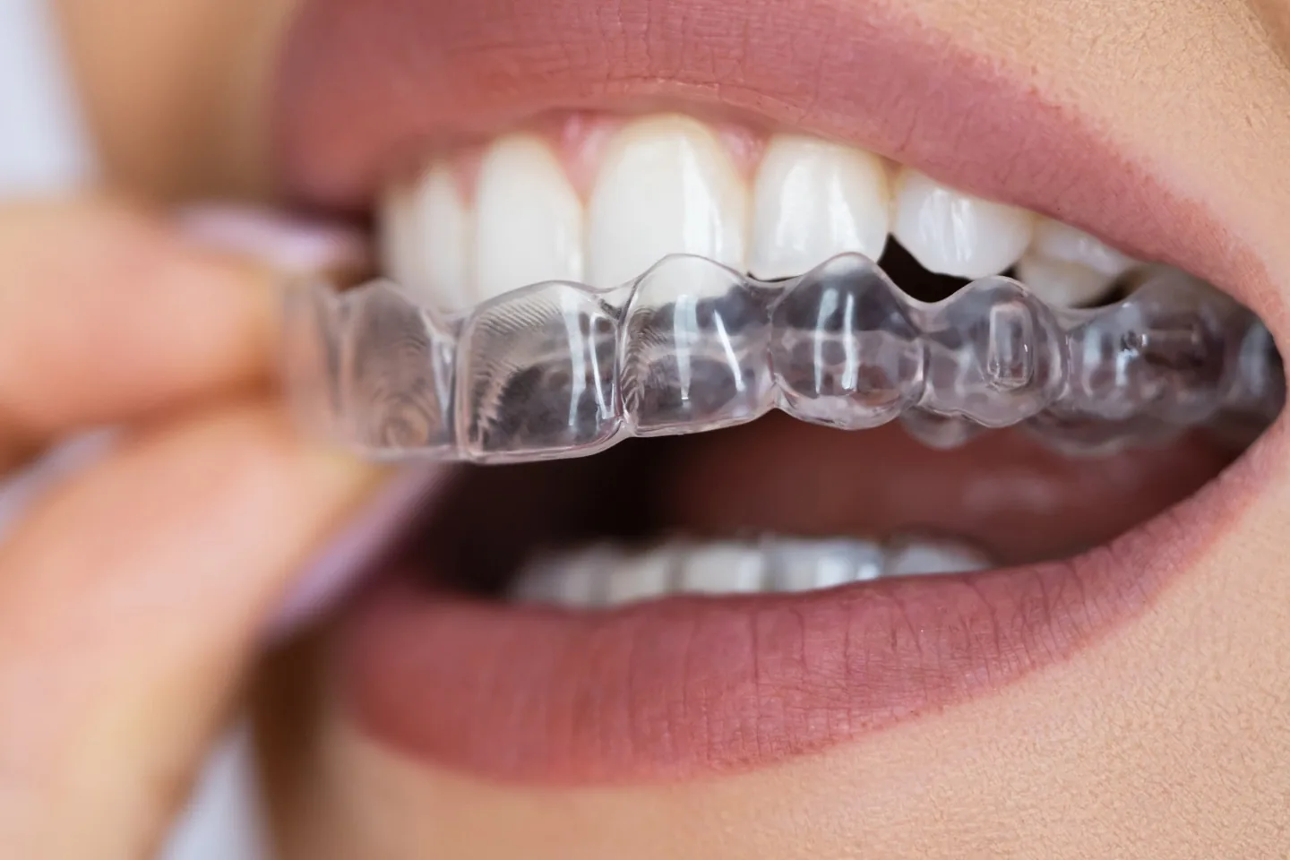 Paciente colocándose un alineador transparente de ortodoncia invisible