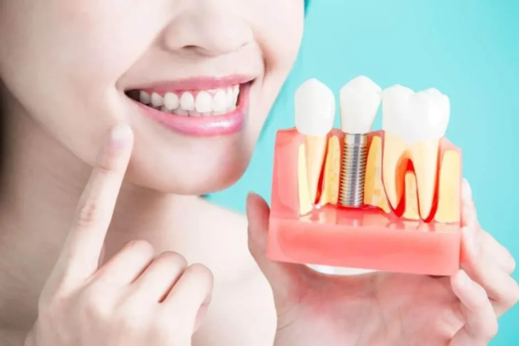 Que hago luego de colocarme implantes dentales Córdoba Argentina