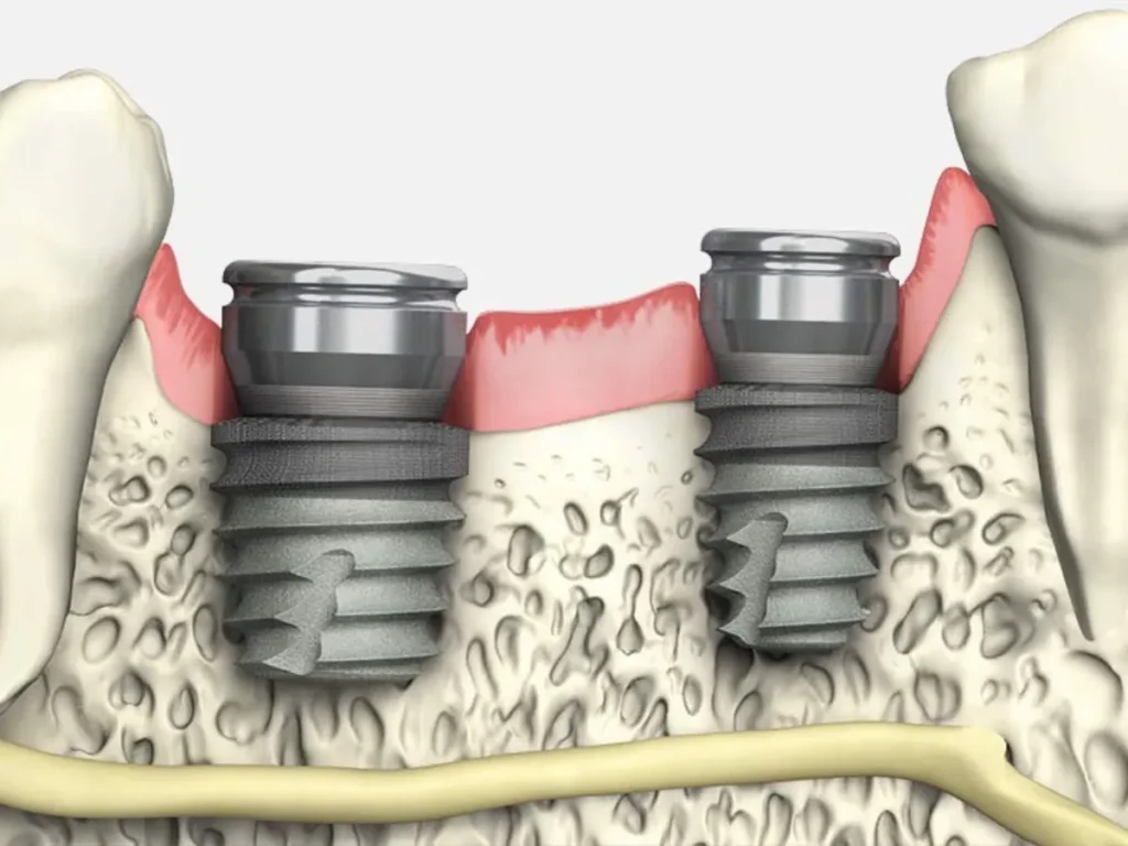 Cuidados tras la colocación de implantes dentales