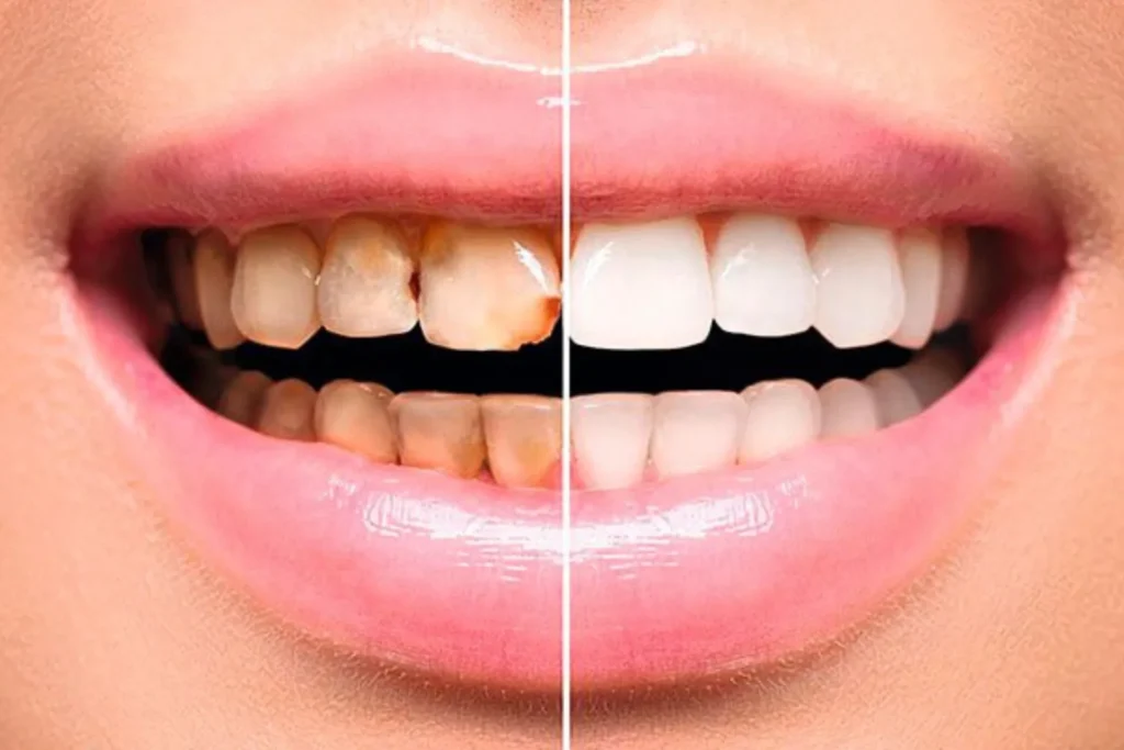 Todo lo que necesitas saber sobre carillas dentales Córdoba Argentina